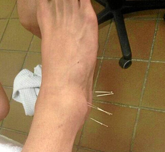 Acupuntura para el tobillo de Perquis