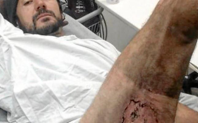 Un iphone 6 explota en el bolsillo y le quema la pierna a un británico