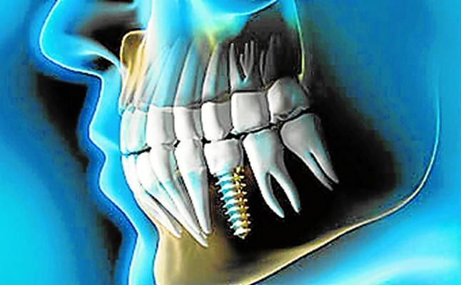 Implantes dentales y el deporte