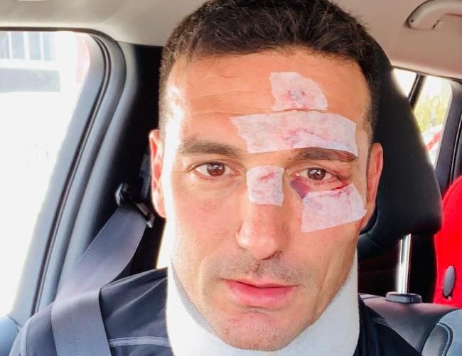 Scaloni, herido tras sufrir un atropello en bicicleta