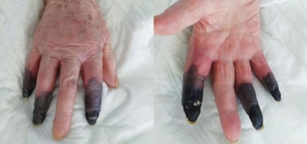 Le amputan tres dedos tras sufrir un efecto secundario provocado por el coronavirus