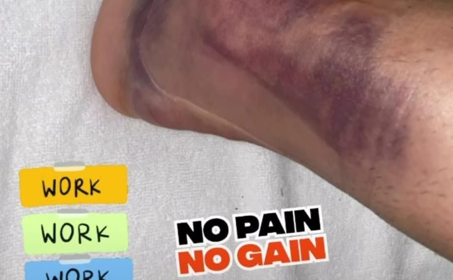 El increíble estado del tobillo de Ceballos 24 horas después de su lesión