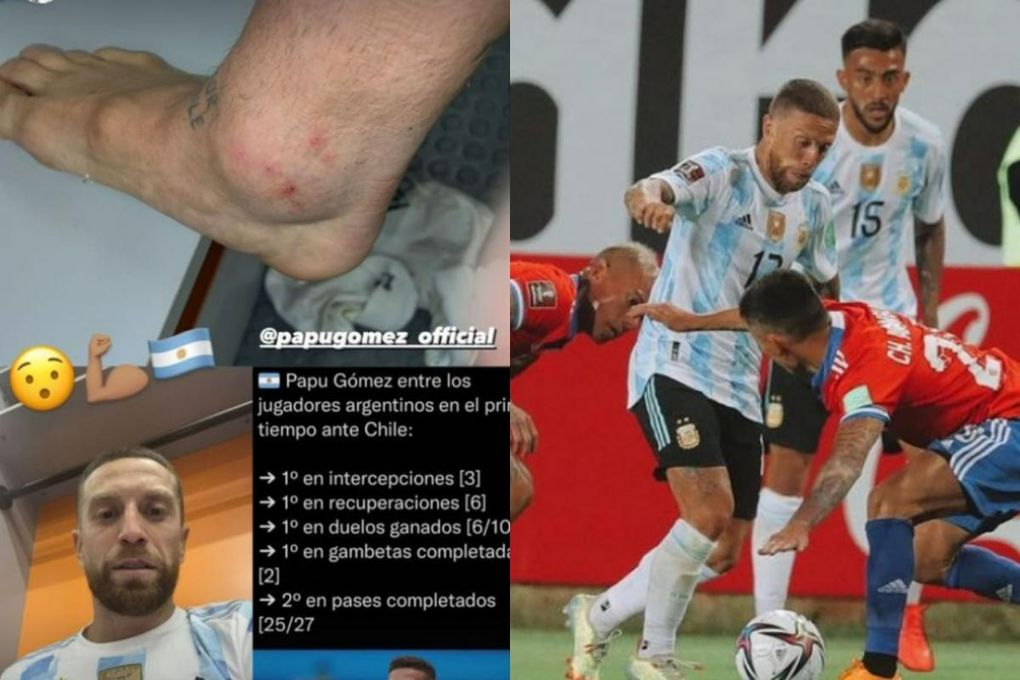 Así quedó el tobillo del Papu Gómez tras el Chile-Argentina