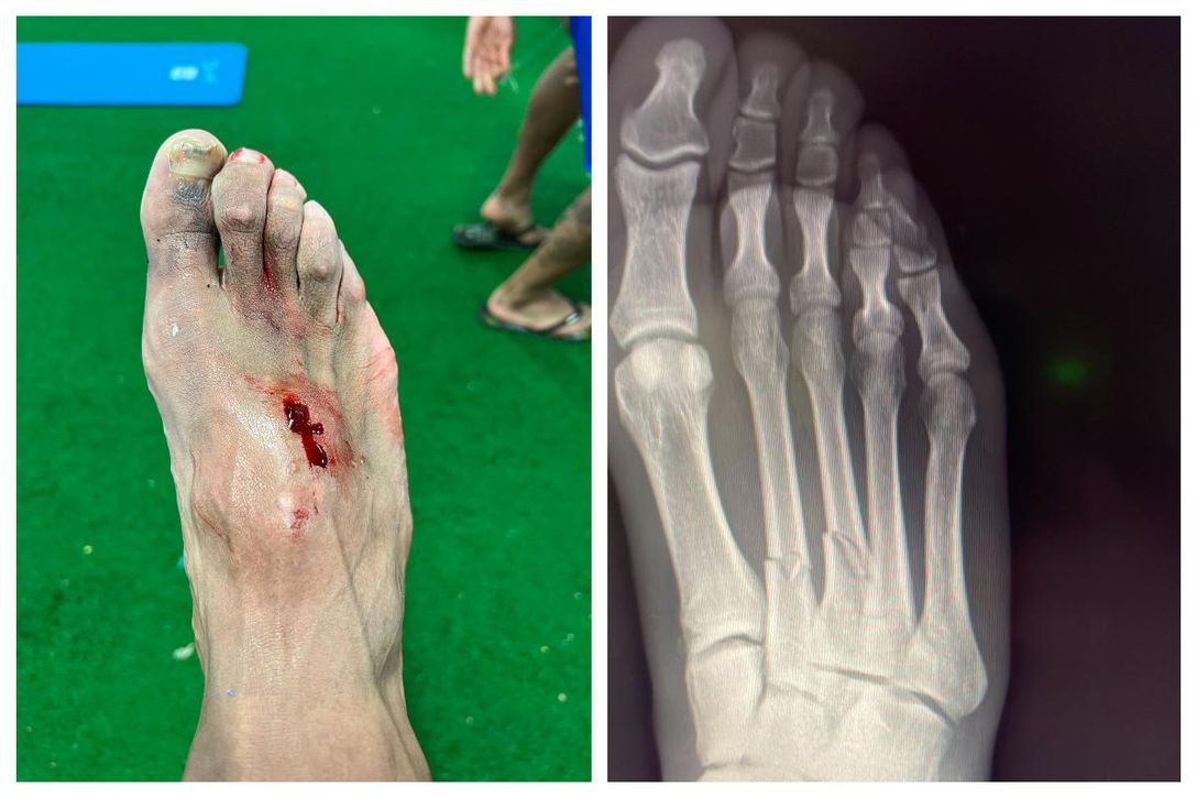 Así quedó el pie de Akapo tras la dura entrada de Hazard y por la que estará de baja dos meses