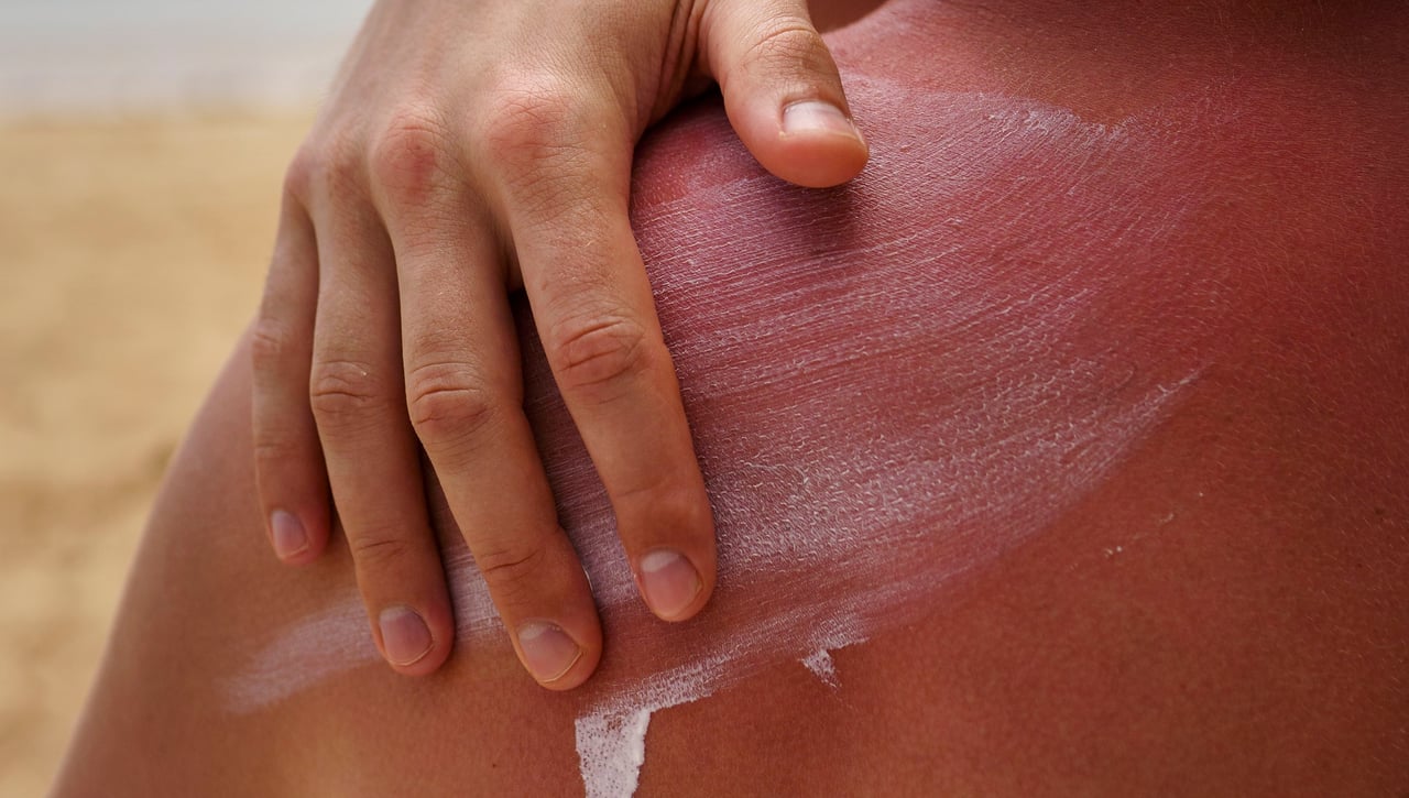 Qué es la tanorexia, la adicción que sufren los más jóvenes