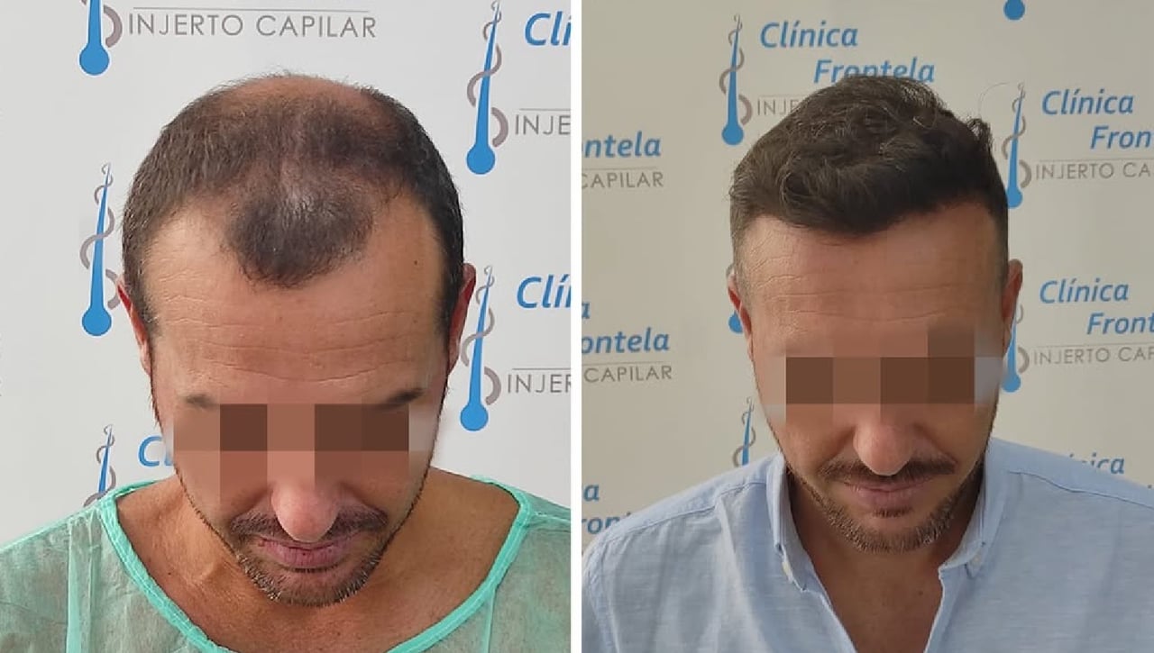 Clínica Capilar Frontela: más de una década de liderazgo en injerto capilar y una red en plena expansión en España