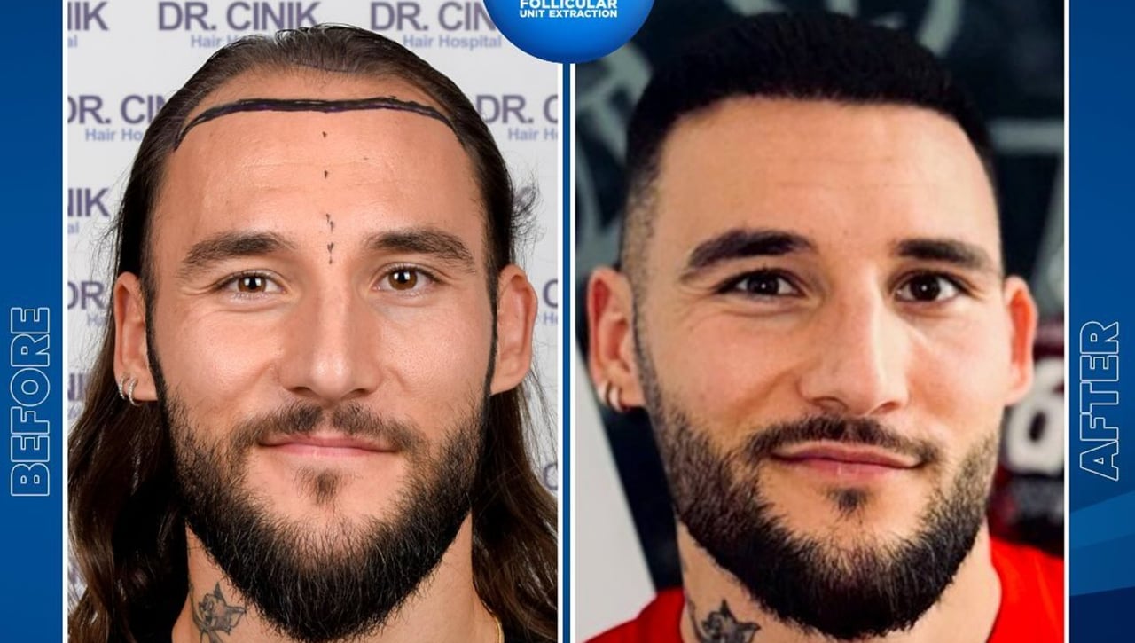 Gudelj, "emocionado" por los resultados de su trasplante capilar en Turquía... gracias a Rakitic