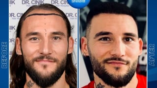 Gudelj, "emocionado" por los resultados de su trasplante capilar en Turquía... gracias a Rakitic