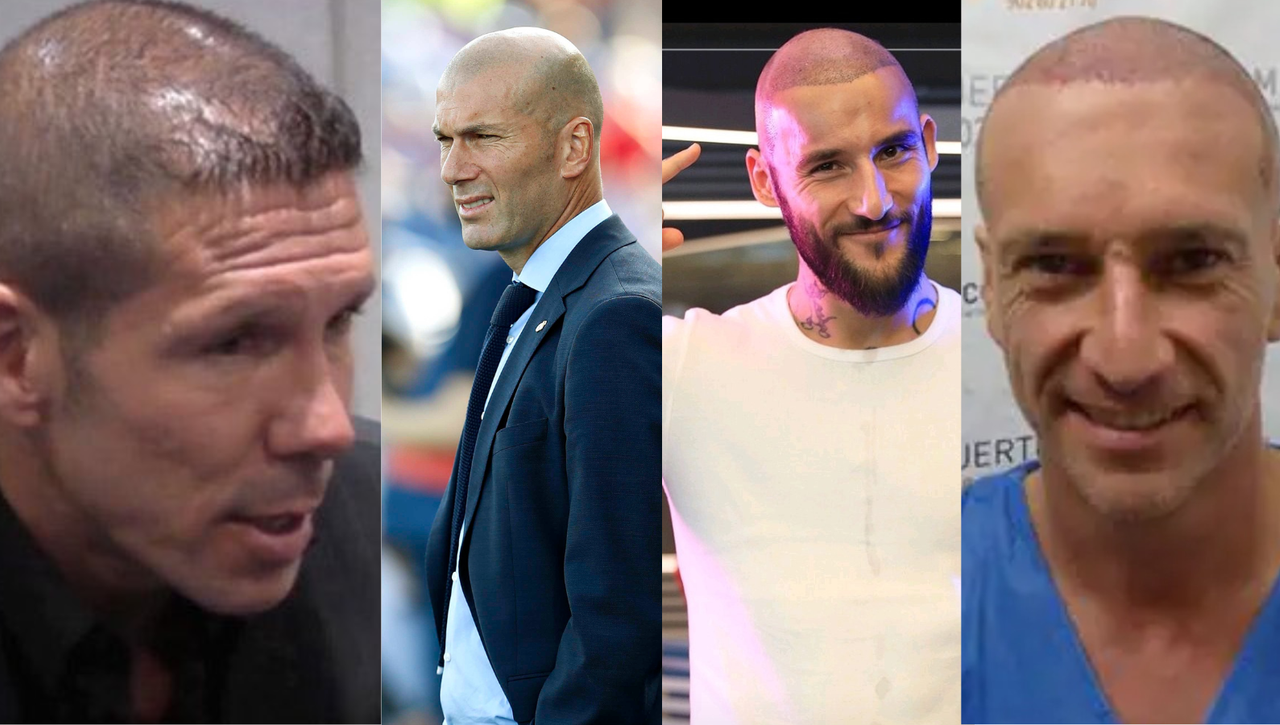 Día Mundial de los calvos: Los injertos capilares y las calvas más famosas del fútbol