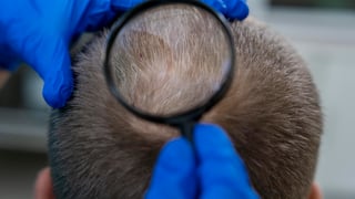 El final de la alopecia más cerca que nunca